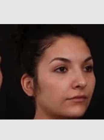 After Image: Rhinoplasty - right-front-oblique