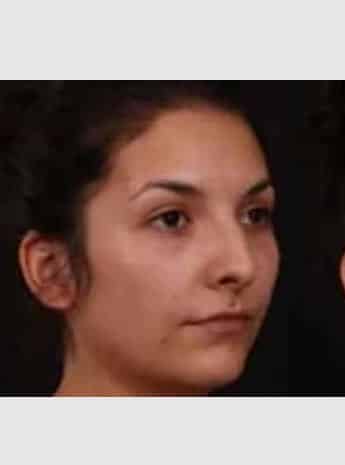 Before Image: Rhinoplasty - right-front-oblique