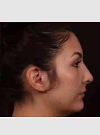 After Image: Rhinoplasty - right-side