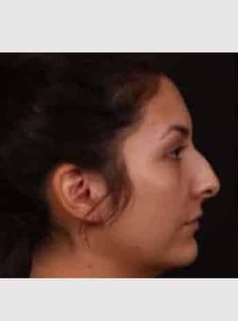 Before Image: Rhinoplasty - right-side