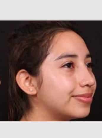 After Image: Rhinoplasty - right-front-oblique