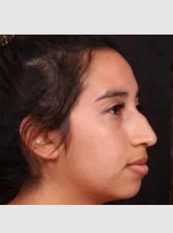 Before Image: Rhinoplasty - right-front-oblique