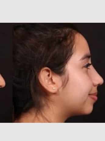 After Image: Rhinoplasty - right-side