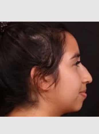 Before Image: Rhinoplasty - right-side
