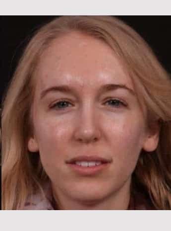 After Image: Rhinoplasty - front