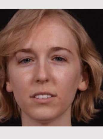 Before Image: Rhinoplasty - front