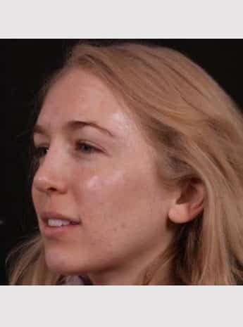 After Image: Rhinoplasty - left-front-oblique
