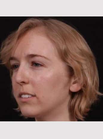 Before Image: Rhinoplasty - left-front-oblique
