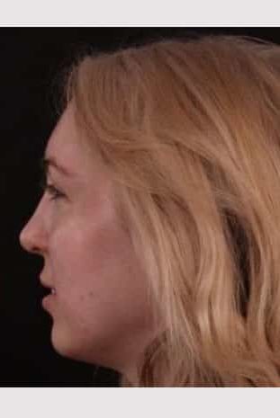 After Image: Rhinoplasty - left-side