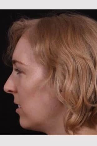 Before Image: Rhinoplasty - left-side