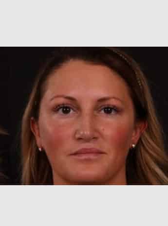 After Image: Rhinoplasty - front