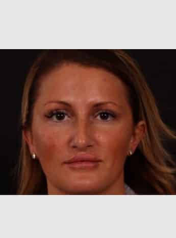 Before Image: Rhinoplasty - front