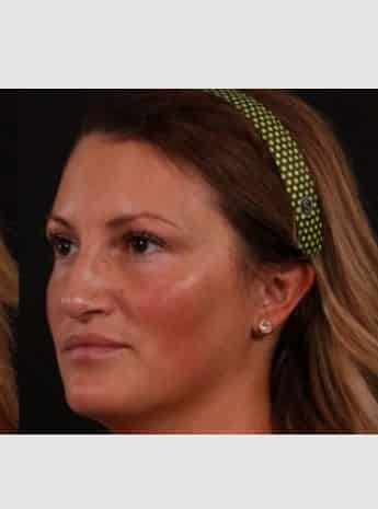 After Image: Rhinoplasty - left-front-oblique