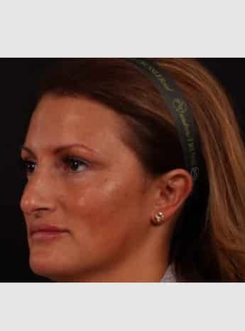 Before Image: Rhinoplasty - left-front-oblique