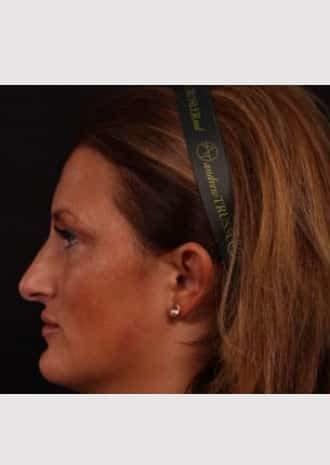 Before Image: Rhinoplasty - left-side