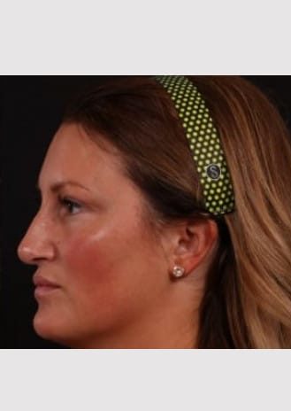 After Image: Rhinoplasty - left-side