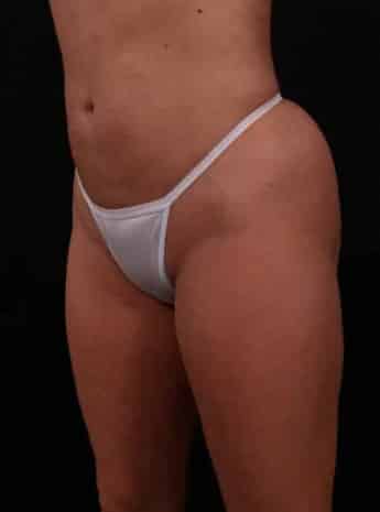 After Image: Liposuction - left-front-oblique