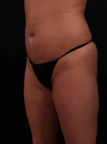 Before Image: Liposuction - left-front-oblique