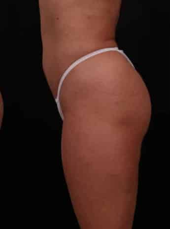 After Image: Liposuction - left-side