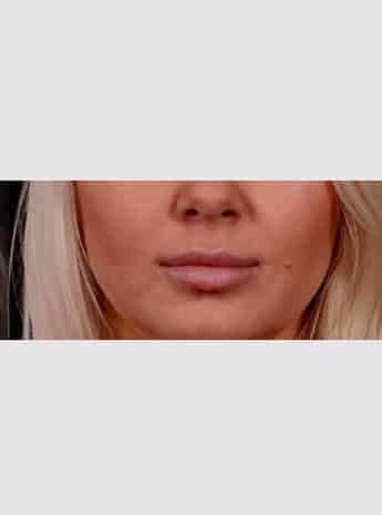 After Image: Lip Lift - front