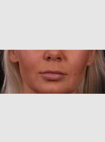 Before Image: Lip Lift - front