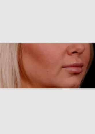 After Image: Lip Lift - right-front-oblique