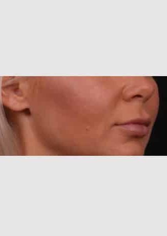 Before Image: Lip Lift - right-front-oblique