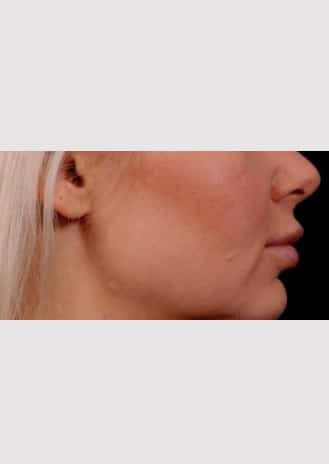 After Image: Lip Lift - right-side