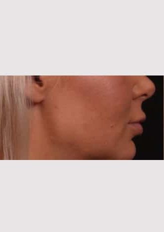 Before Image: Lip Lift - right-side