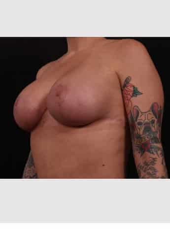 After Image: Mastopexy (Breast Lift) - left-front-oblique