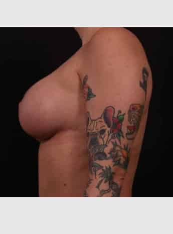 After Image: Mastopexy (Breast Lift) - left-side