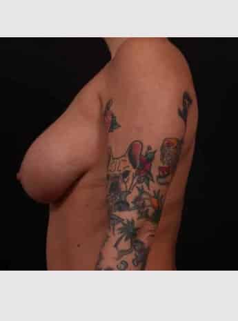 Before Image: Mastopexy (Breast Lift) - left-side