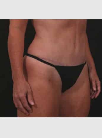 After Image: Tummy Tuck - right-front-oblique