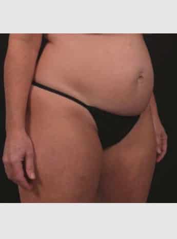 Before Image: Tummy Tuck - right-front-oblique