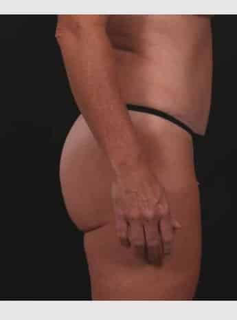 After Image: Tummy Tuck - right-side