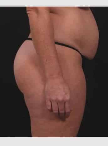 Before Image: Tummy Tuck - right-side