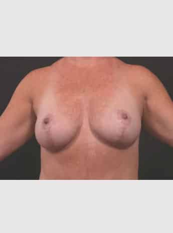 After Image: Mastopexy (Breast Lift) - front