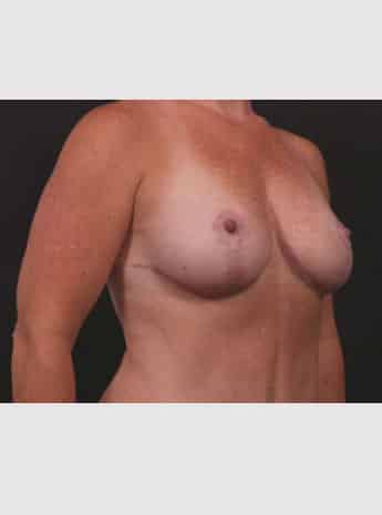 After Image: Mastopexy (Breast Lift) - right-front-oblique