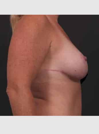 After Image: Mastopexy (Breast Lift) - right-side