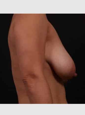 Before Image: Mastopexy (Breast Lift) with Auto Augmentation - right-side