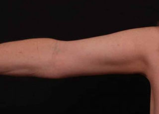 After Image: Brachioplasty (Arm Lift) - front