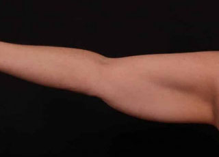 Before Image: Brachioplasty (Arm Lift) - front