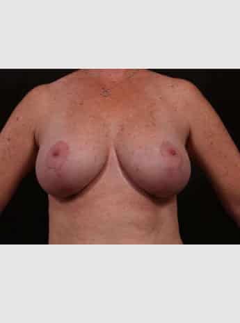 Breast Lift (Mastopexy) with Augmentation