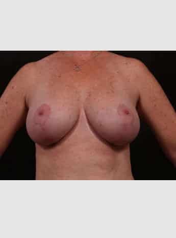 After Image: Breast Lift (Mastopexy) with Augmentation - front
