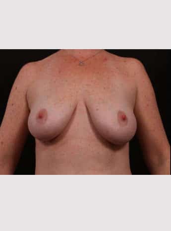 Before Image: Breast Lift (Mastopexy) with Augmentation - front