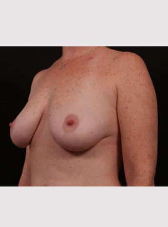 Before Image: Breast Lift (Mastopexy) with Augmentation - left-front-oblique