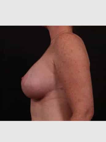After Image: Breast Lift (Mastopexy) with Augmentation - left-side