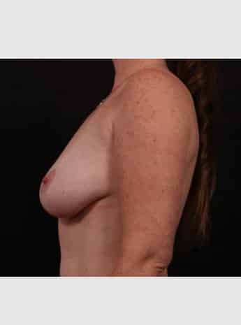 Before Image: Breast Lift (Mastopexy) with Augmentation - left-side