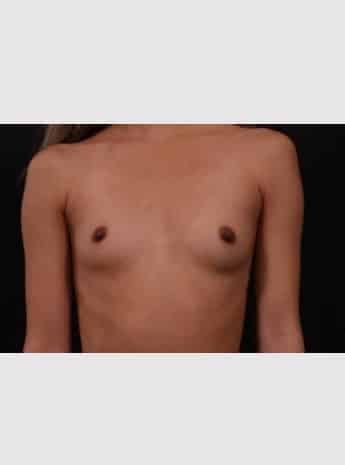 Before Image: Breast Augmentation - front