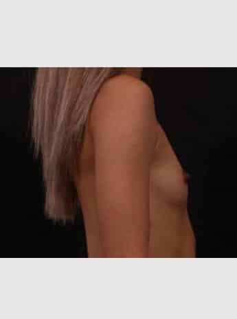 Before Image: Breast Augmentation - right-side